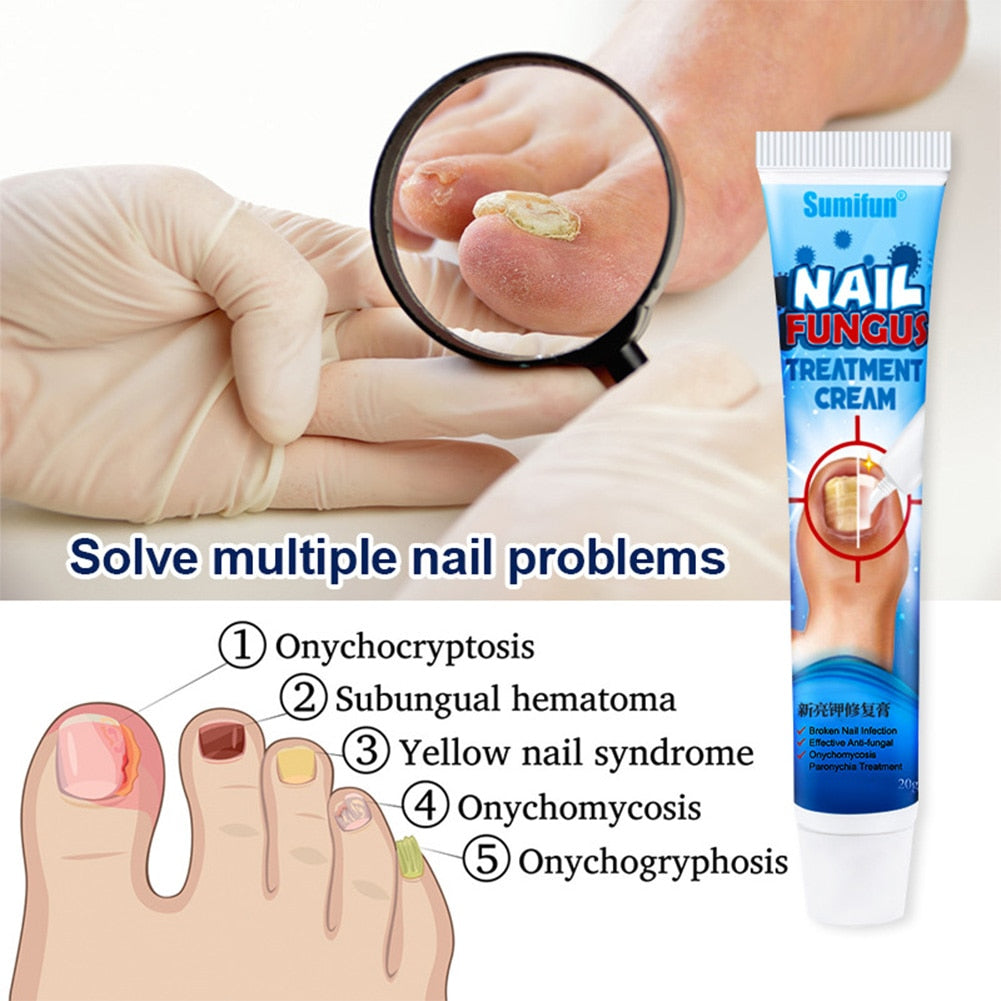 Nail Fungus Repair Cream to Promote New Nail Growth