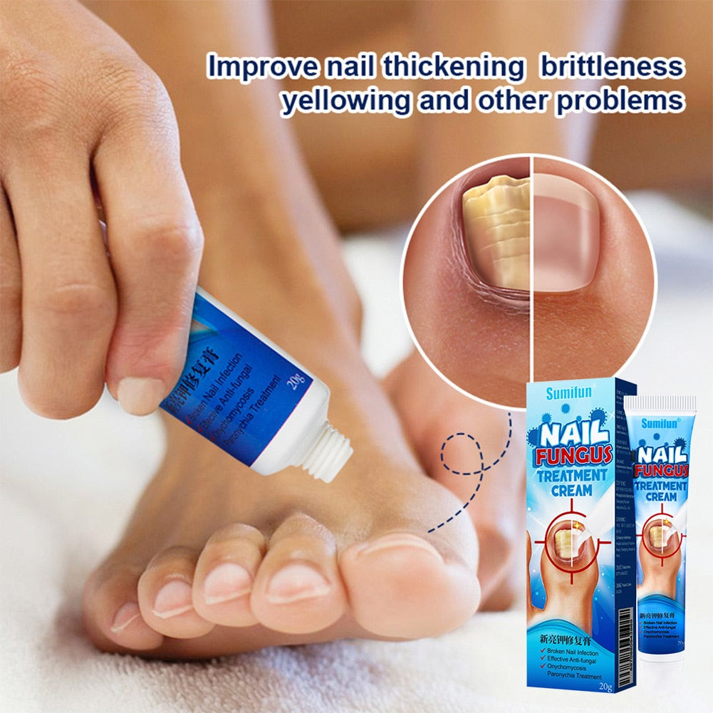 Nail Fungus Repair Cream to Promote New Nail Growth