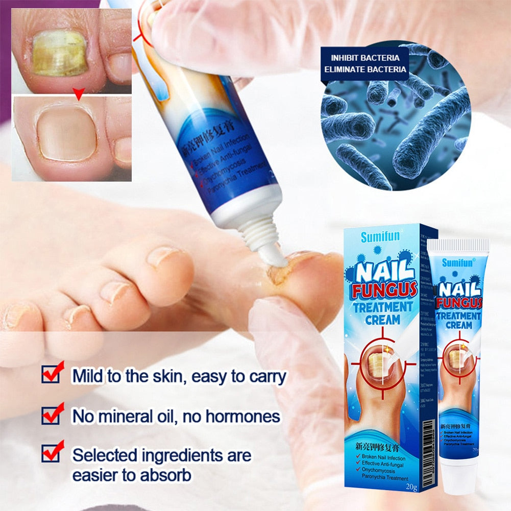 Nail Fungus Repair Cream to Promote New Nail Growth