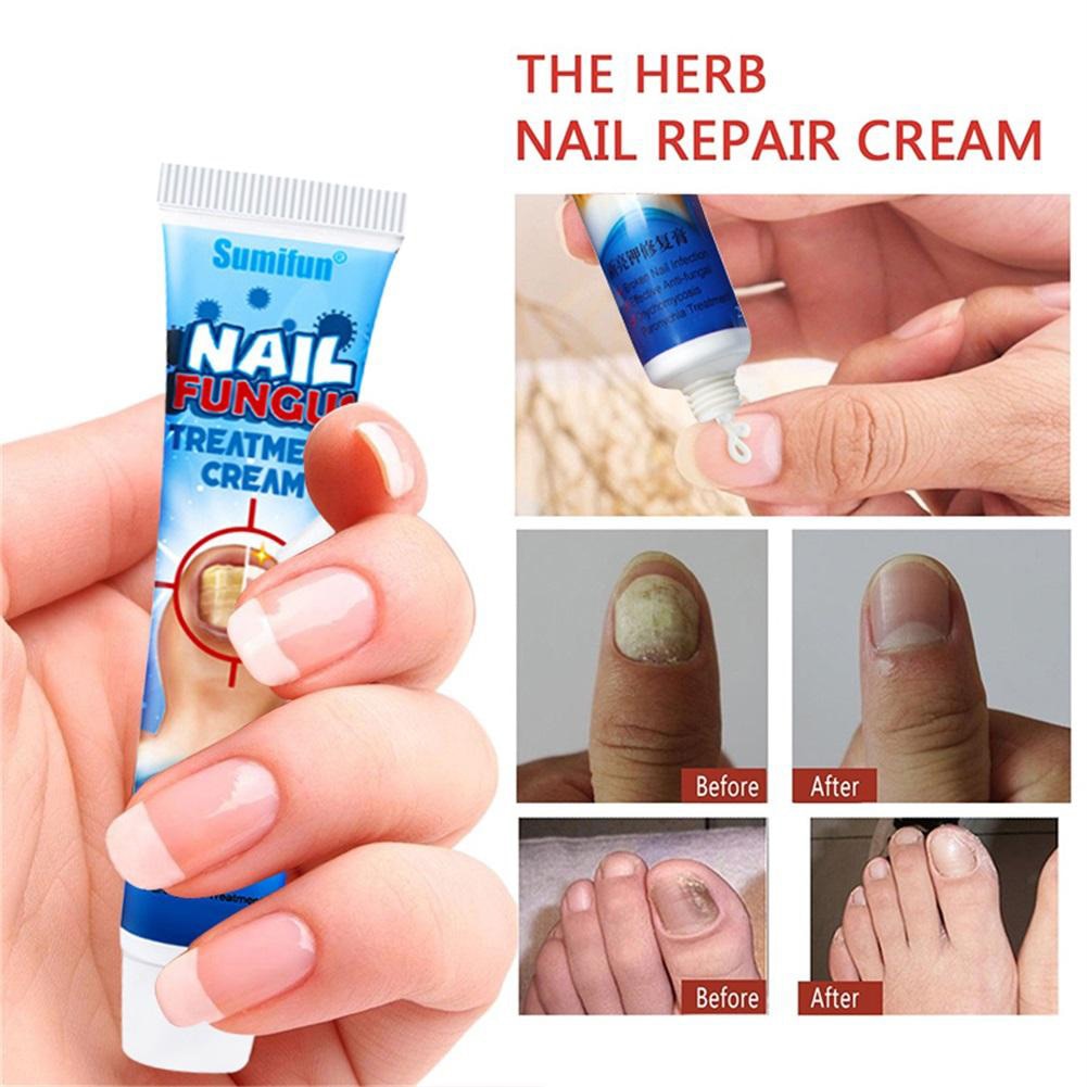 Nail Fungus Repair Cream to Promote New Nail Growth